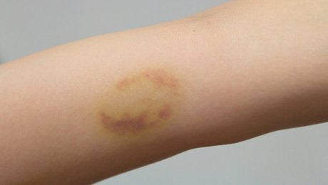 8 Raisons Qui Expliquent Les Hématomes Sur Votre Corps - Minutefacile.com