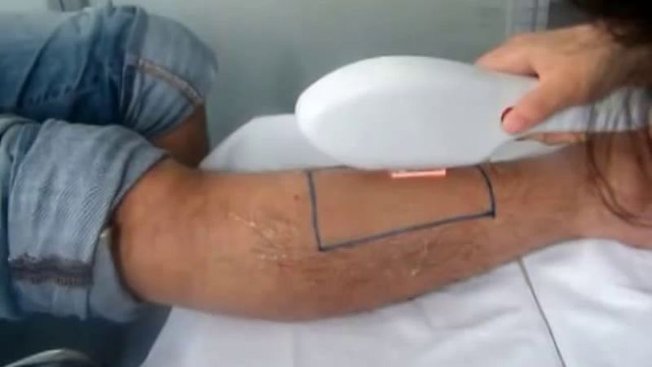seance epilation definitive seance epilation definitive