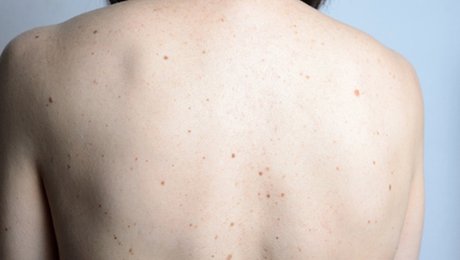 Enlever Un Grain De Beauté Naturellement Minutefacile Com