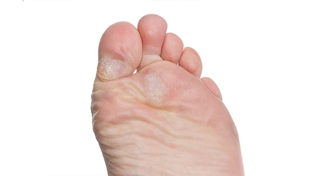 Les cors au pied