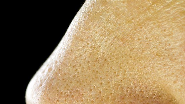 Le traitement des pores dilatés